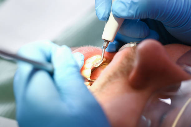 Best Emergency Treatment for Dental Infections or Abscesses in Peebles, OH